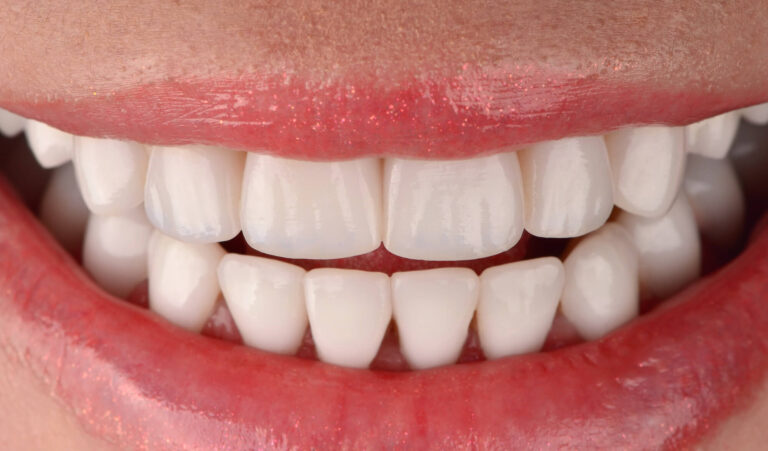 Minimally invasive teeth preparation and prosthetics with all-ceramic crowns
