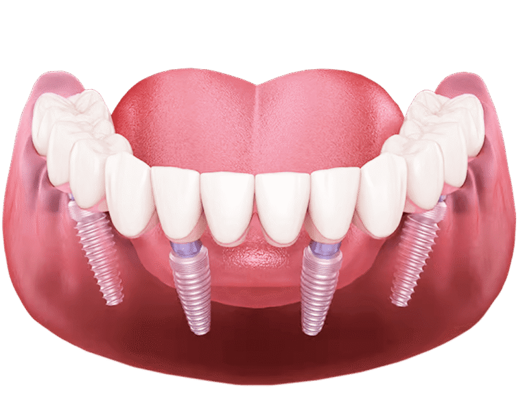 Сравнение All-on-6 и All-on-4. Фото до