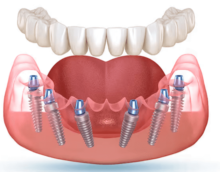 Сравнение All-on-6 и All-on-4. Фото после