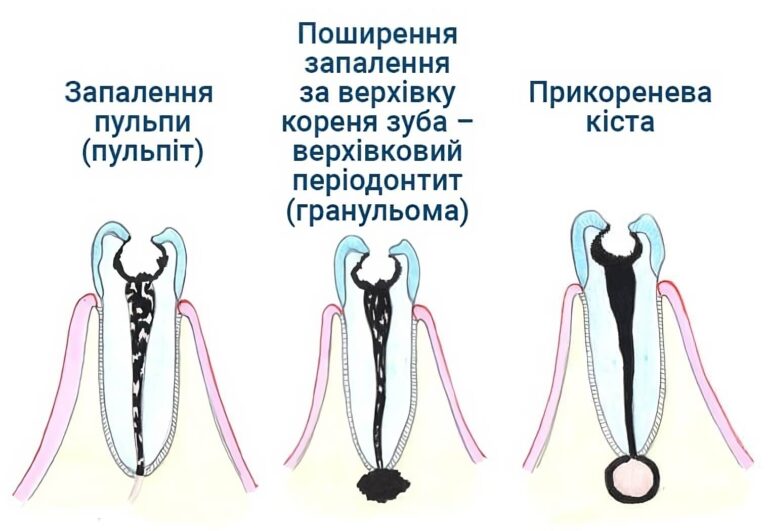 Зубний канал