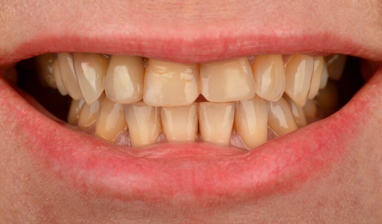 What are dental prosthetics. Photo before