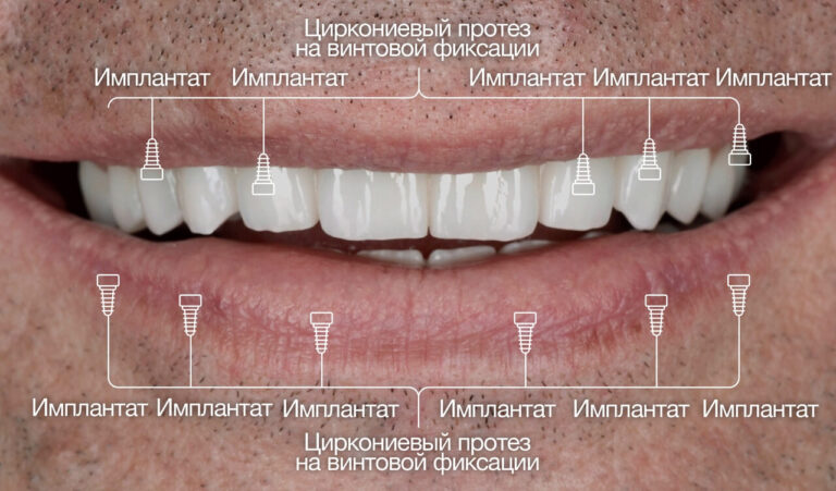 Возможные осложнения: воспаление дёсен, отторжение.... Фото после