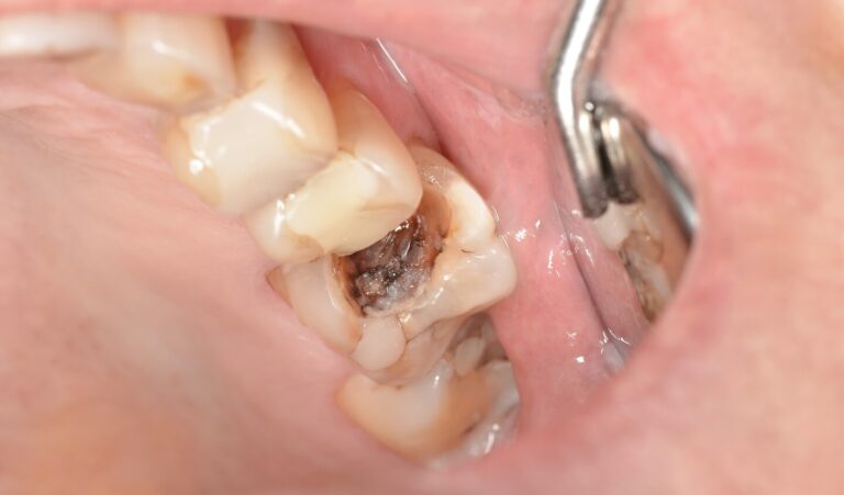Causes of tooth decay. Photo before