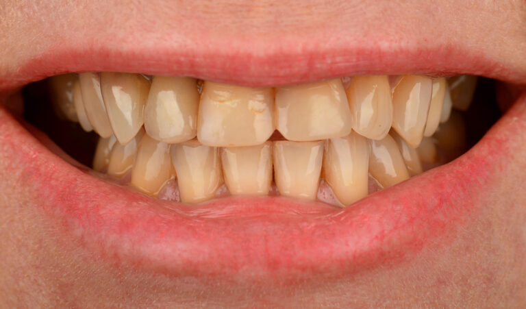 Replacement of inappropriate photopolymer restorations for ceramic veneers