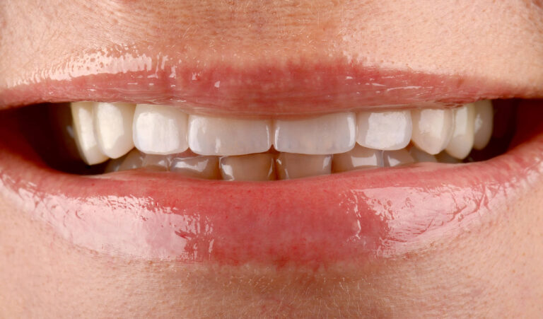 Replacement of inappropriate photopolymer restorations for ceramic veneers