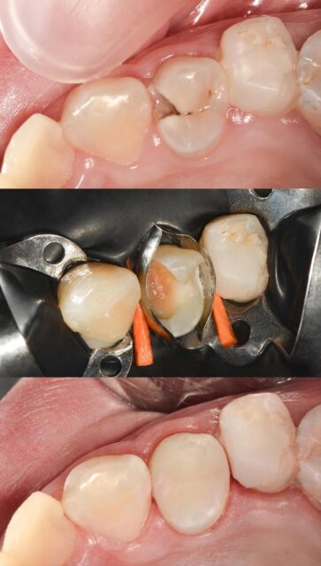 Symptoms of tooth decay Illustration