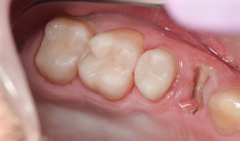 image-lk1-after