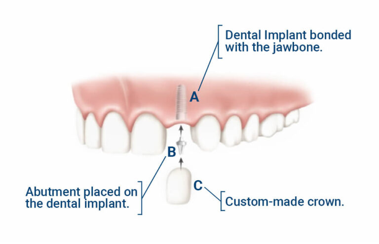 Stages of implantation. Illustration