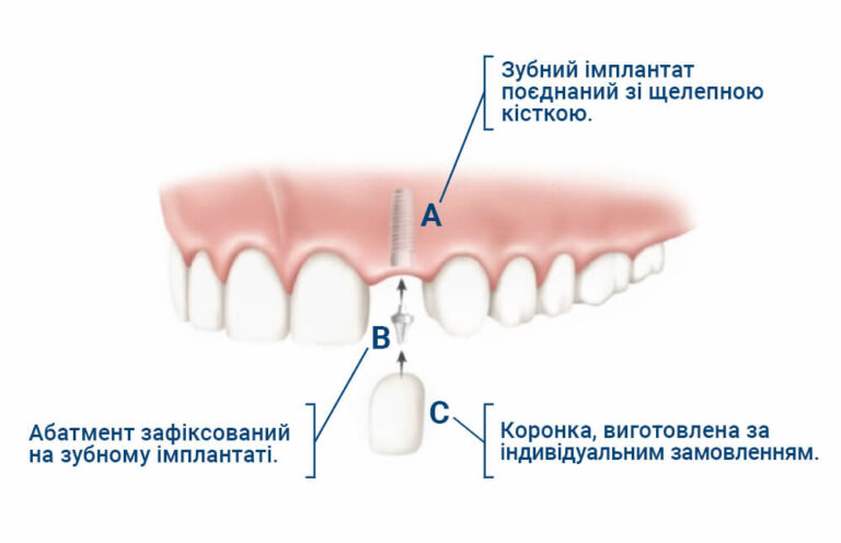 Етапи імплантації. Ілюстрація