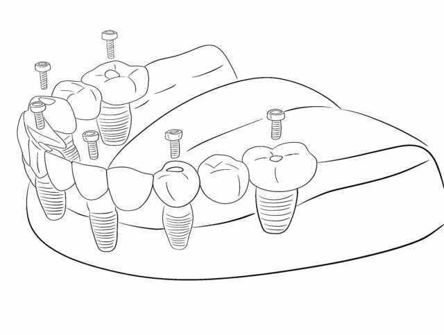 Имплантация All-on-4 и All-on-6
Методика для... Иллюстрация