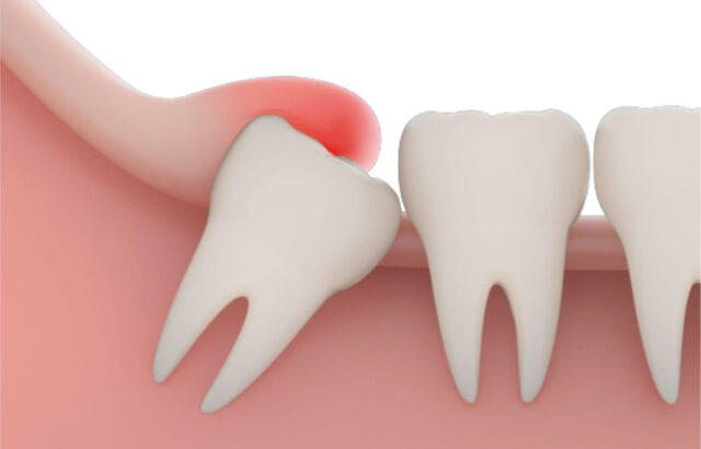 Wisdom Tooth Extraction: Yes or No? Illustration