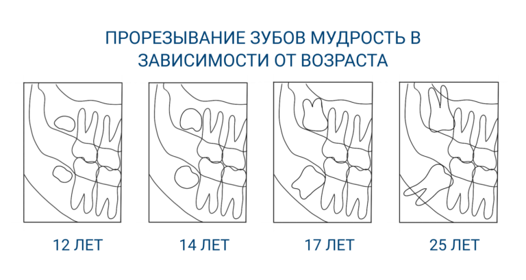teething-wisdom-ru