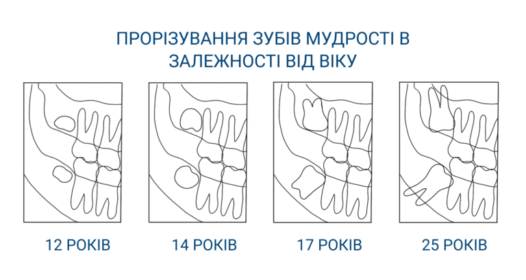 teething-wisdom-ua