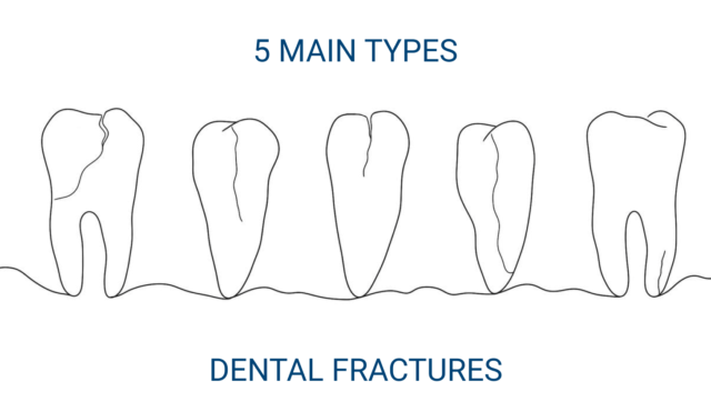 Tooth fractures