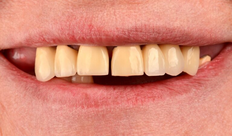 All-on-4 protocol with severe generalized periodontitis