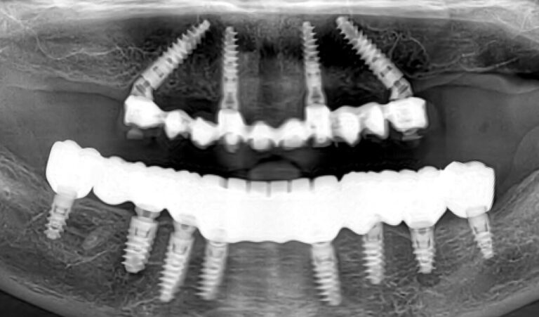 Implantological rehabilitation of a patient with complicated caries caused by improper prosthetics