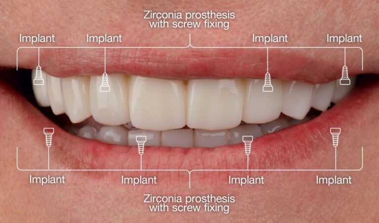 All-on-4 protocol with severe generalized periodontitis
