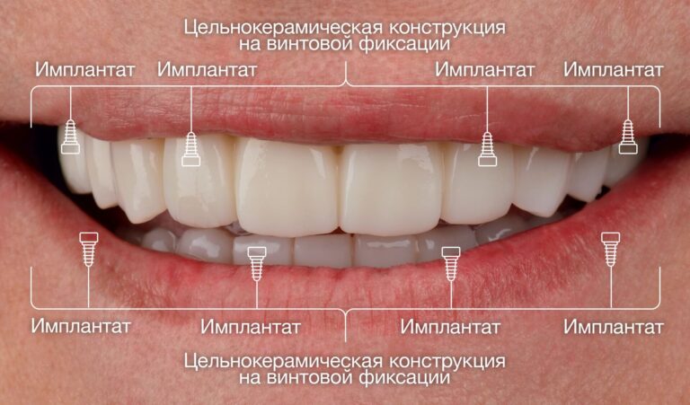 All-on-4 при тяжёлом пародонтите и выраженной атрофии кости челюсти