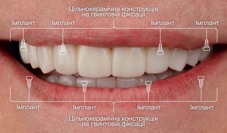 All-on-4 при важкому пародонтиті та вираженій атрофії кістки щелепи
