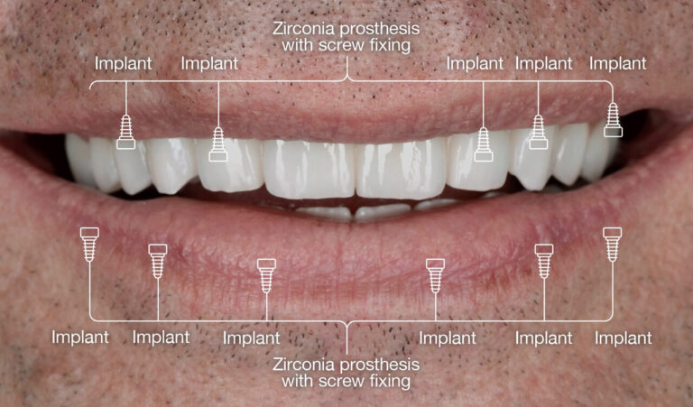 Full Mouth Rehabilitation with Zirconia Implant-Supported Crowns
