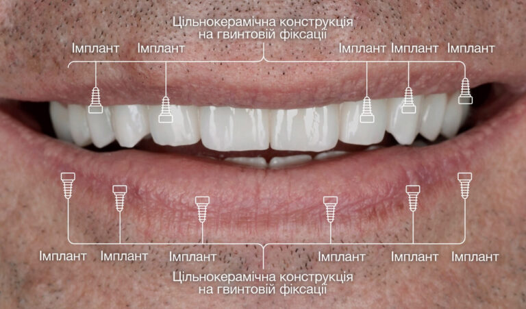 Тотальна реабілітація обох щелеп цирконієвими коронками з опорою на імплантати