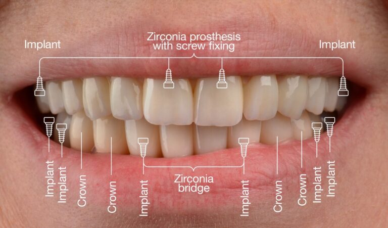 All-on-4 Benefits. Photo after