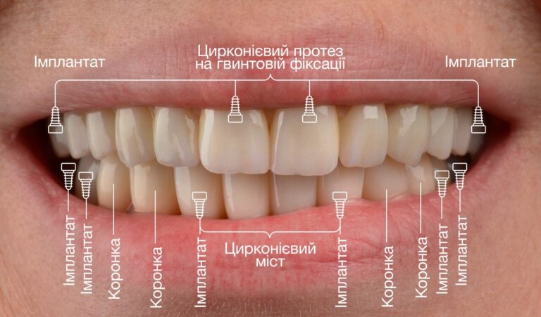 Переваги All-on-4. Фото після