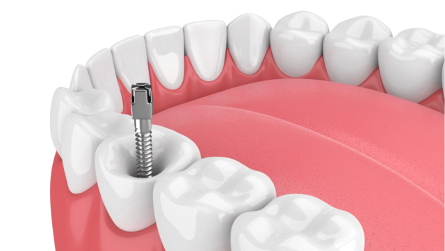 Pros and cons of tooth posts Illustration