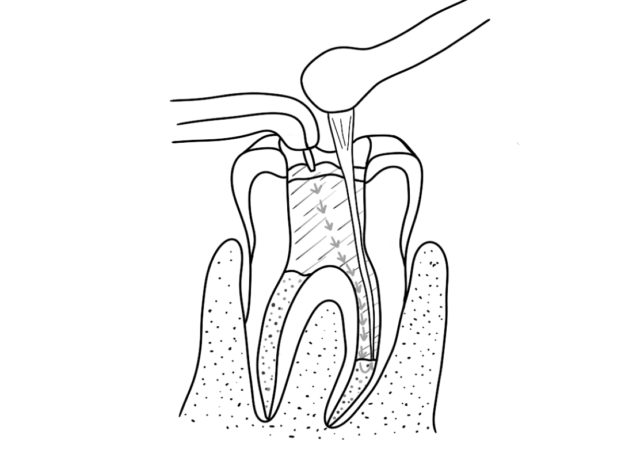 What Is a Root Canal Treatment Illustration