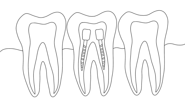 What is tooth post and what it is for Illustration