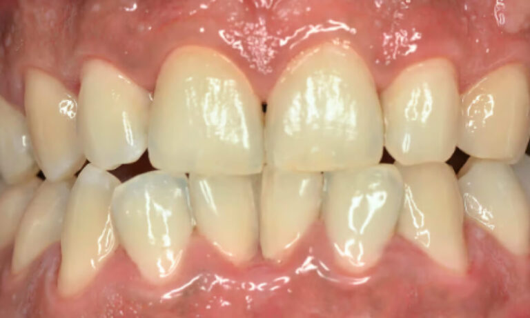 Advantages of ultrasonic dental tartar removal. Photo after