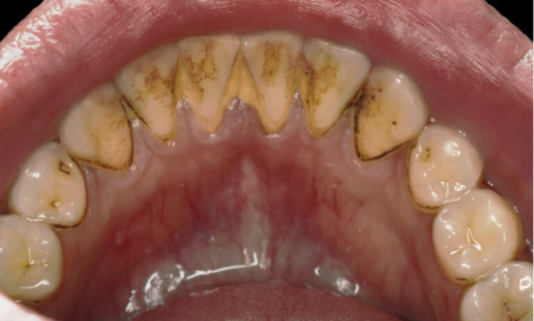 How does the Airflow method work?. Photo before