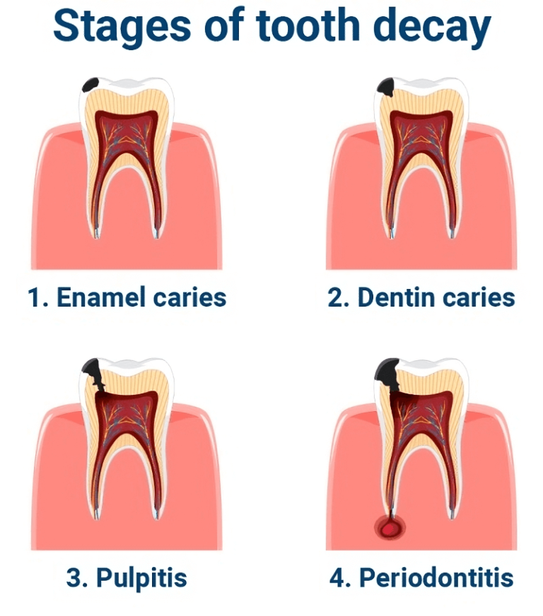 Stages of tooth decay