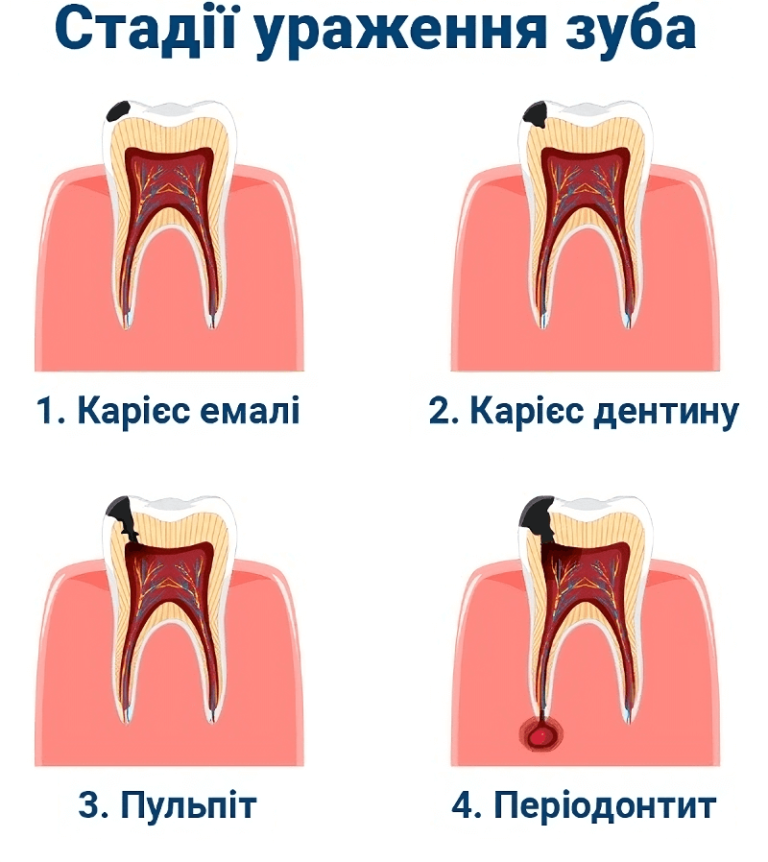 Стадії ураження зуба
