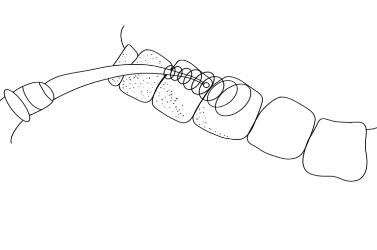 tooth-crown+inlay-02 1