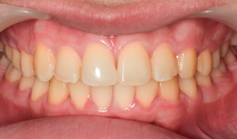 What are sapphire braces?. Photo after