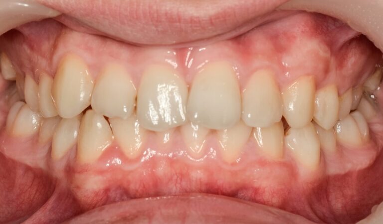 What are sapphire braces?. Photo before