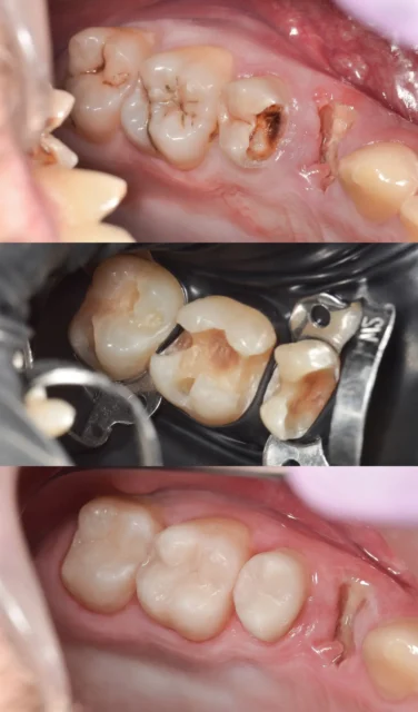Root surface decay Illustration