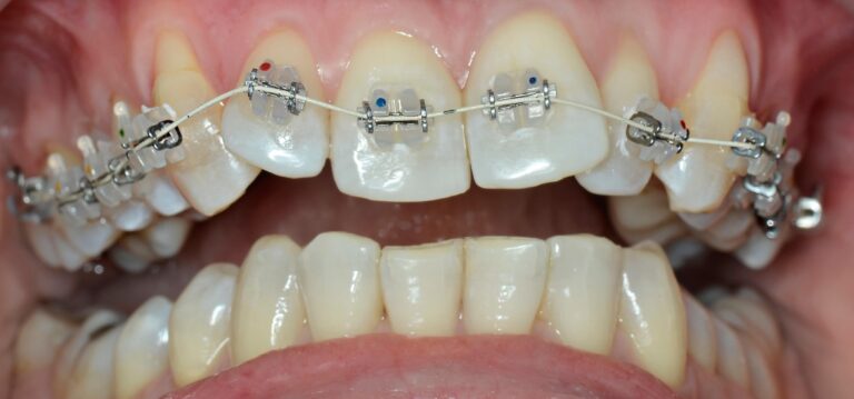 Advantages of self-ligating braces?. Photo before