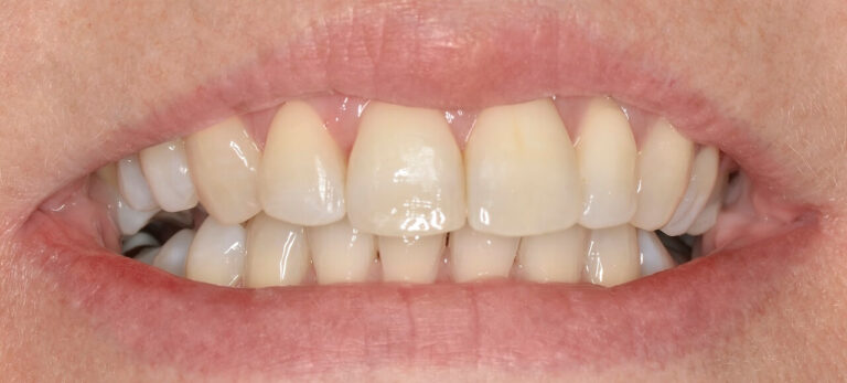 Advantages of self-ligating braces?. Photo after