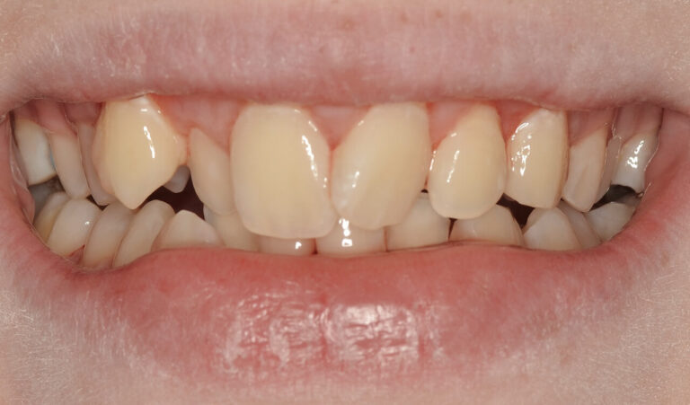 Care After Fitting. Photo before