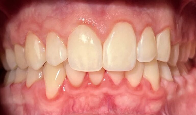 Care After Fitting. Photo after