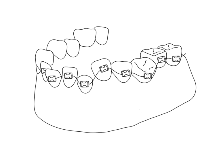 braces-image-09746