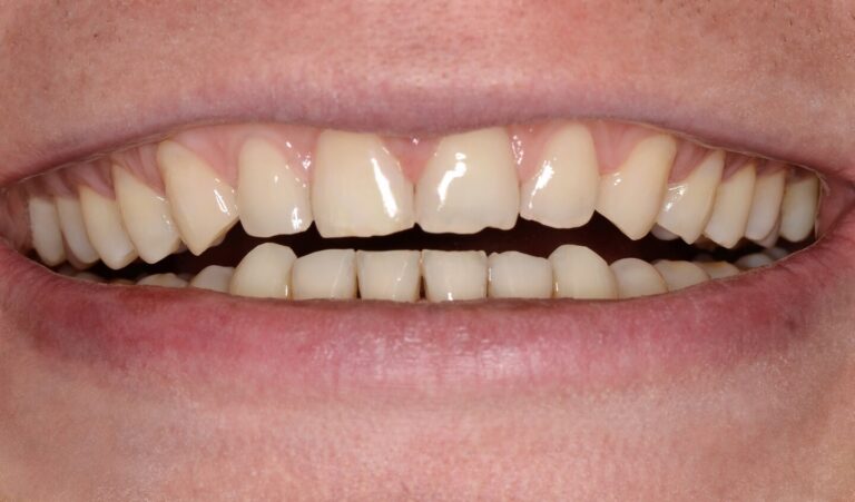 Indications for Brace System Installation. Photo after