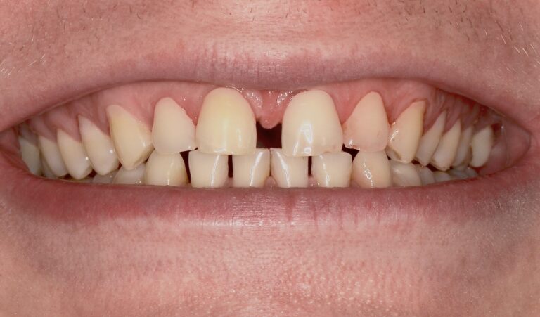 Indications for Brace System Installation. Photo before