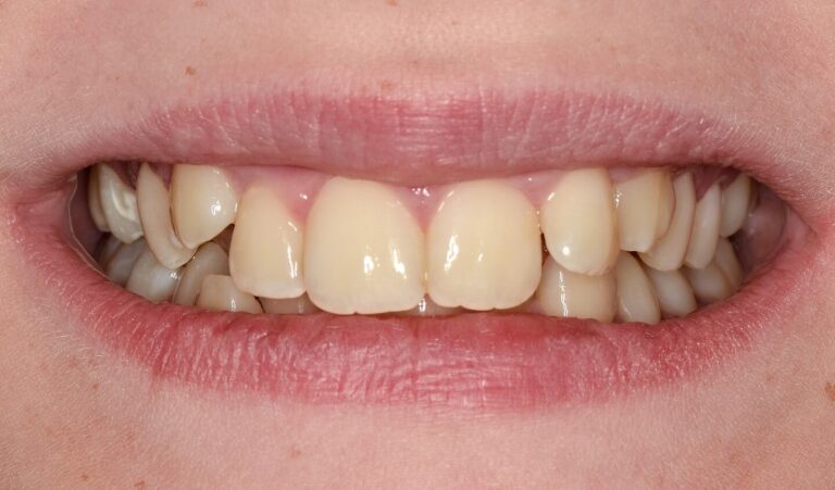 What Are Ceramic Braces?. Photo before