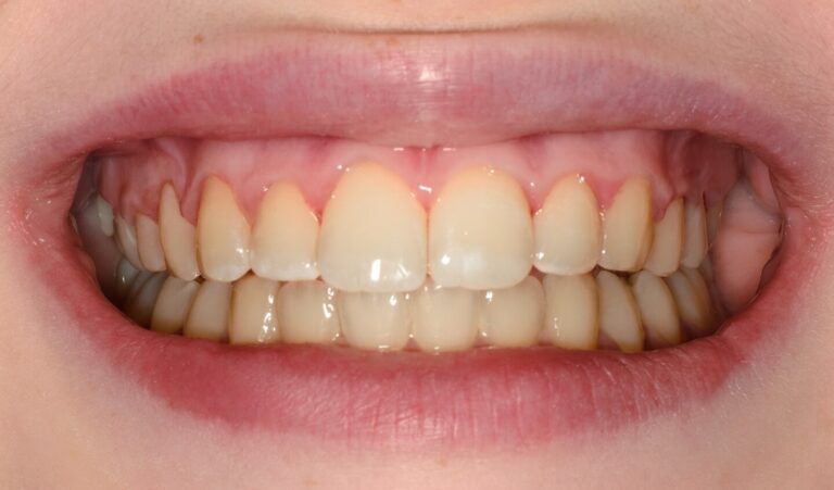 What Are Ceramic Braces?. Photo after