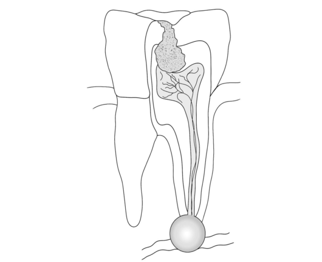 What is a deep cavity? Illustration