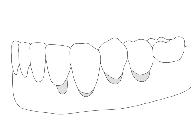 Cervical Caries Illustration