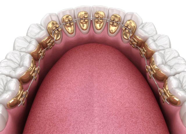 The process of placing the inner part of the system Illustration
